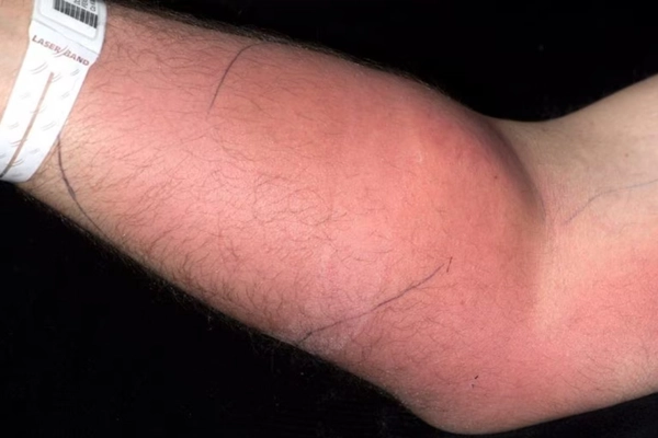 อย่าหาทำ! แพทย์เผยชายฉีดอสุจิเข้าเส้น หวังรักษาปวดหลัง สุดท้ายเป็นฝีหนอง