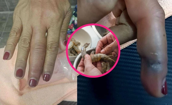 เตือน เปลือกกุ้งทิ่มมือ เสี่ยงติดเชื้อรุนแรงถึงขั้นเนื้อตาย