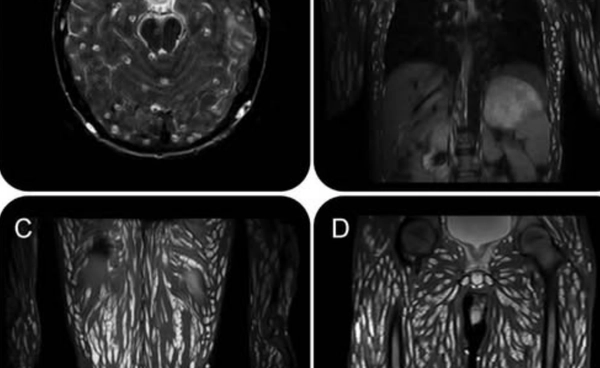 เผยภาพคนไข้มี "ถุงตัวอ่อนของพยาธิตืดหมู" กระจายทั่วร่างกาย เหตุกินผักดิบ ล้างไม่สะอาด