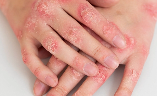 ดราม่าวัดพระบาทน้ำพุ ปมบริจาคและสิทธิผู้ป่วย HIV กลุ่มเปราะบาง