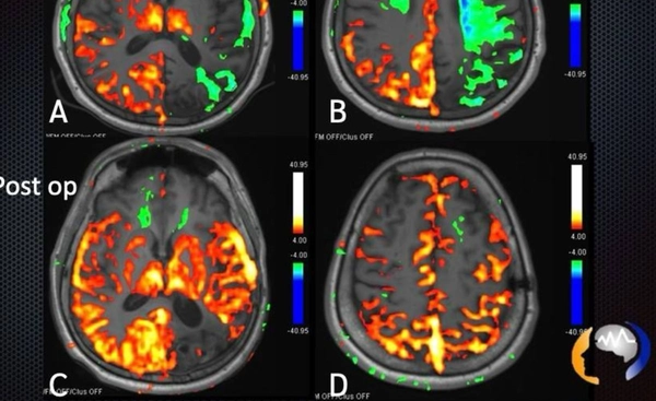 เทคโนโลยี BOLD MRI รักษาโรคหลอดเลือดโมยาโมย่า อย่างแม่นยำ
