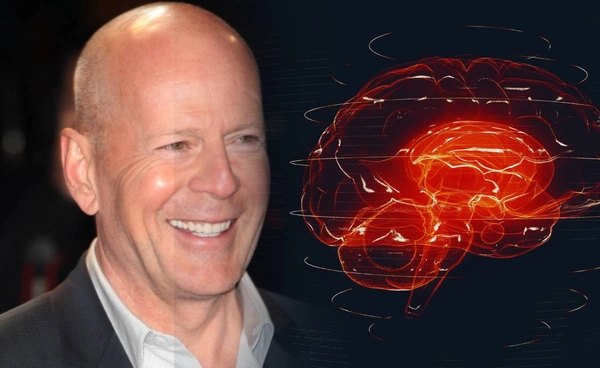 รู้จัก โรคสมองส่วนหน้าเสื่อม อาการป่วยของ บรูซ วิลลิส ล่าสุด พูด อ่าน เดินไม่ได้แล้ว