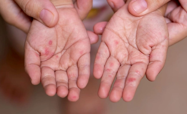 โรคมือ เท้า ปากระบาด ในเด็กเล็ก 8 เดือนป่วย 65.7% มากว่าปีที่แล้วเกินเท่าตัว