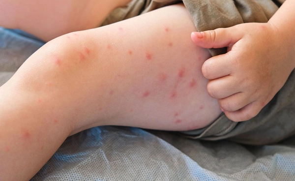 เฝ้าระวังโรคหัดระบาดชายแดน ป่วยเพิ่มขึ้นในภาคเหนือ ทั่วปท. สะสมเกือบ 2 พันราย 