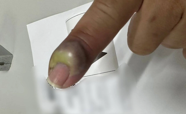 ช่างอาบน้ำแมวเกือบเสียนิ้ว หลังถูกแมวข่วนจนแผลติดเชื้อ ต้องเข้าผ่าตัดด่วน