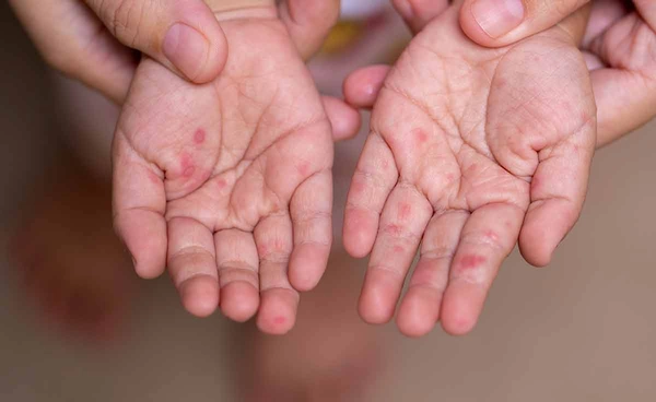 "โรคมือเท้าปาก" ระบาดฤดูฝนป่วยแล้ว  2.1 หมื่นราย เด็กเล็กเสี่ยงสูง 