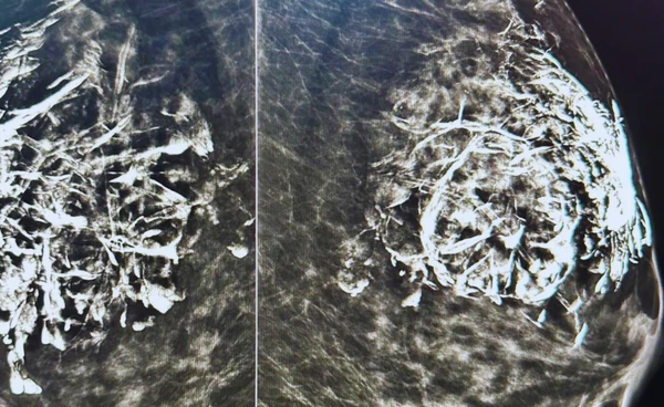 เตือนอย่าฉีด “CaHA” ที่เต้านม เสี่ยงกระตุ้นเนื้อผิดตำแหน่ง ร้ายแรงต่อสุขภาพ