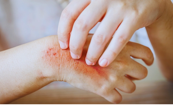 เตือนโรคผื่นกุหลาบเสี่ยงต่อการแท้งบุตร