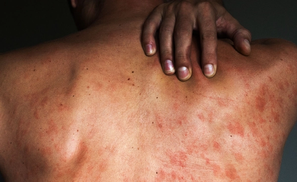ตีแผ่ตัวเลขน่าห่วง วัยรุ่นไทยติด HIV เฉลี่ยเกือบ 360 คนต่อเดือน ปี 68