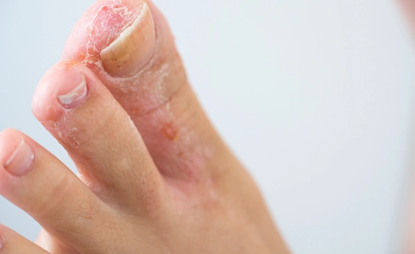 น้ำกัดเท้าดูแลอย่างไร วิธีดูแลและป้องกันอย่างถูกต้อง