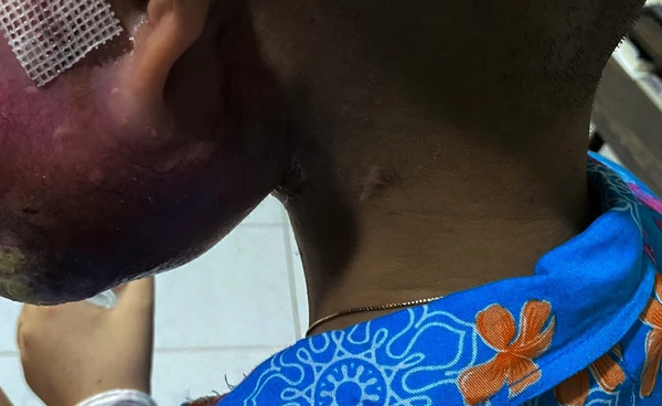 มะเร็งซาโคม่ากระดูก คืออะไร อาการเป็นอย่างไร รักษาได้ไหม? 