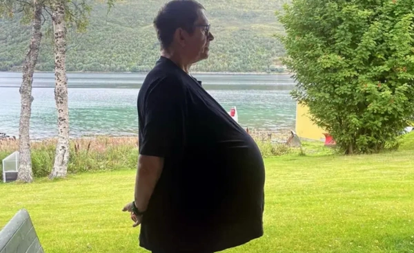 คิดว่าตัวเองอ้วนมา 12 ปี ที่แท้คือเนื้องอกหนักกว่า 27 กก.