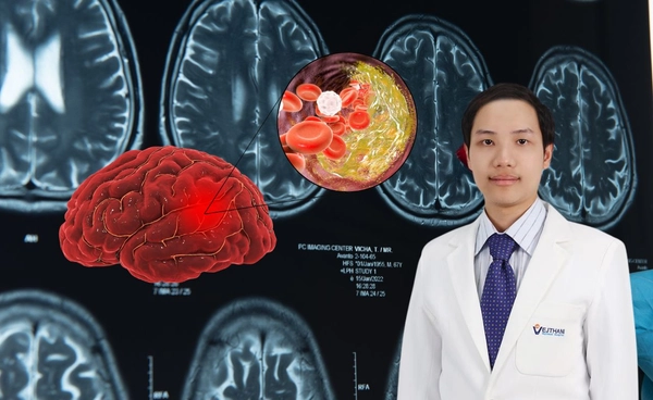 รักษาหลอดเลือดสมองอุดตัน ด้วยเทคนิคการลากลิ่มเลือดผ่าน Biplane DSA ลดความเสียหายต่อสมอง