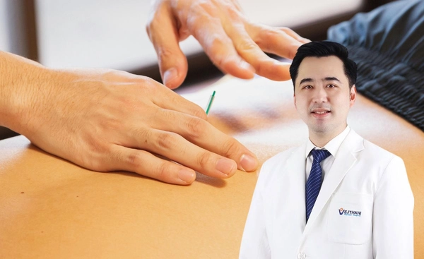 หยุดความปวดจากออฟฟิศซินโดรม ด้วยการฝังเข็ม Dry Needling