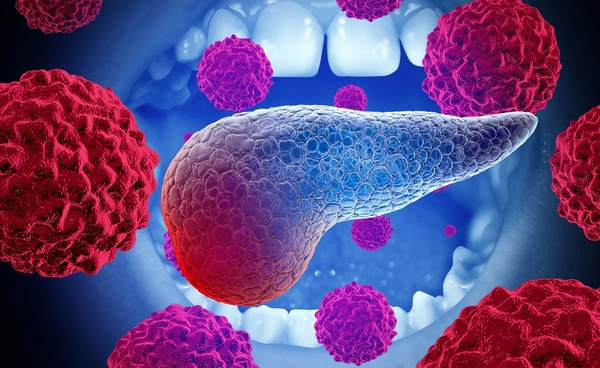 จุลินทรีย์ในช่องปากอาจเป็นสาเหตุของมะเร็งตับอ่อน วิจัยชี้