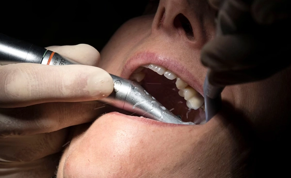 ขูดหินปูนด้วยตัวเอง ทันตแพทย์ เตือน! แฝงไปด้วยอันตราย