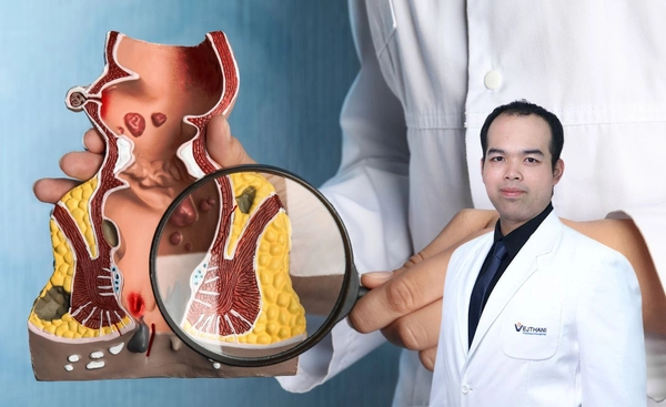 รักษาริดสีดวงไม่ต้องผ่าด้วยเทคโนโลยีเลเซอร์  NeoLaser 