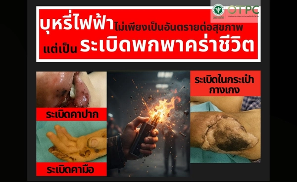 เตือนภัยบุหรี่ไฟฟ้าระเบิดเสี่ยงบาดเจ็บรุนแรงถึงชีวิต