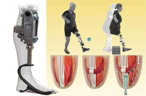 พัฒนาขาเทียมเชื่อมกับกระดูก-กล้ามเนื้อ ทำให้คนใส่รู้สึกเหมือนเป็นขาจริง