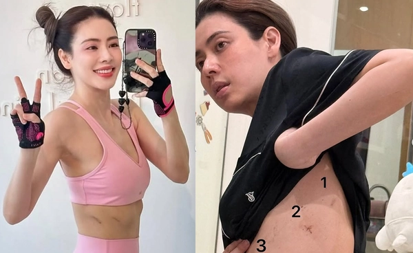 "เอ๋ พรทิพย์" อัปเดตอาการ 1 เดือน รอยแผลทั้งตัว อโหสิกรรมให้กับคนที่สาปแช่ง