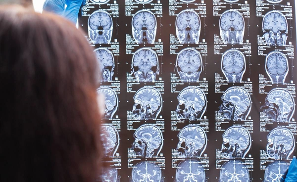 ภาพถ่าย "สมองรับยาแบบเรียลไทม์" ช่วยดูแลผู้ป่วยอัลไซเมอร์