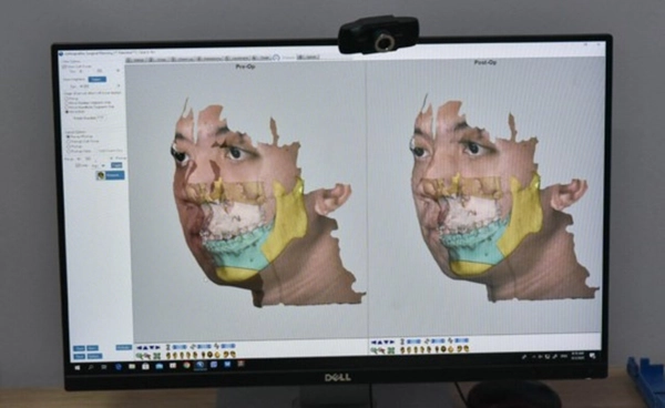 แพทย์ ม.นเรศวร ทำสำเร็จ! ใช้การพิมพ์ไทเทเนียม 3D รักษาผู้ป่วยปากแหว่งเพดานโหว่ แห่งแรกในไทย!