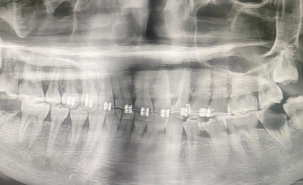 อุทาหรณ์จัดฟันแฟชั่น ฟันผุ มีหนอง ไอ หายใจไม่สะดวก สุดท้ายกลายเป็นเยื่อบุหัวใจติดเชื้อ