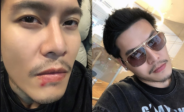 "ดิว เดอะสตาร์ 4" สุดช็อก ติดเชื้อต่อมน้ำเหลืองอักเสบ เพราะใช้ไมค์สาธารณะ