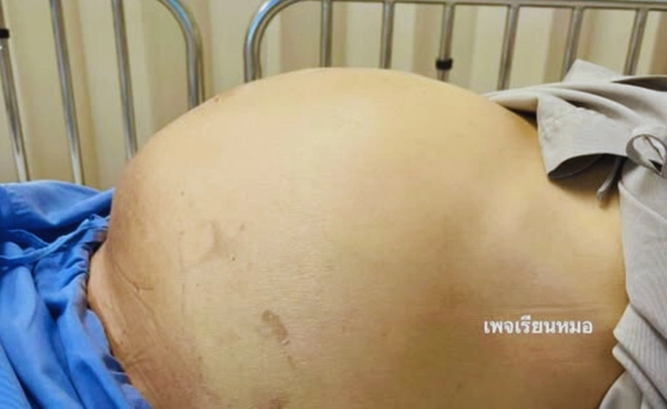 ท้องมานโต เพราะชอบกินปลาดิบ สุดท้ายเป็นมะเร็งท่อน้ำดี 