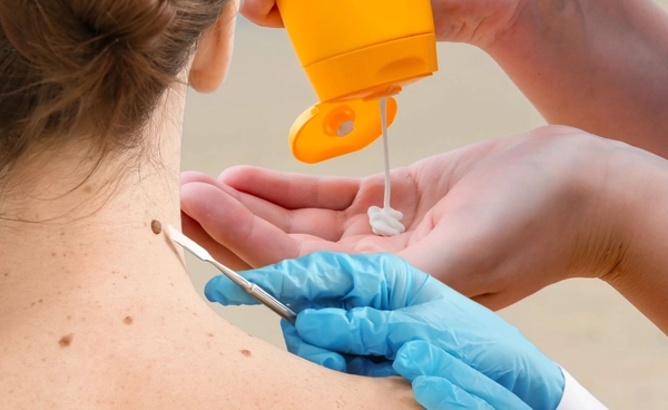 เมื่อครีมกันแดดไร้ผล ถอดบทเรียนสาวออสซี่ป่วยมะเร็งผิวหนัง