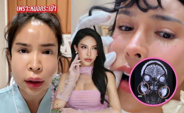 นัท สะบัดแปรง ผ่าตัดดูดหนองออกจากหน้าเหตุจากเคยฉีดหน้าจากหมอกระเป๋า