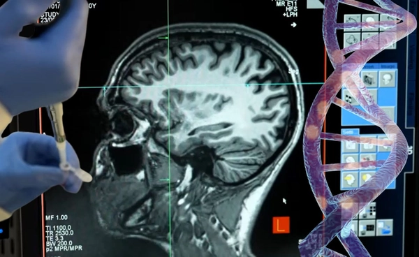 แพทย์ใช้ยีนบำบัด ชะลอโรคฮันติงตัน โรคทางพันธุกรรมหายากสำเร็จ