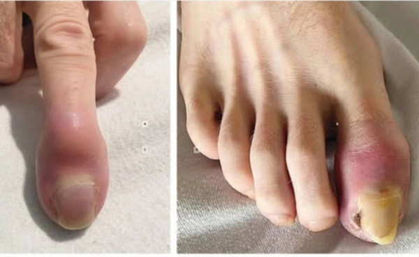 เปิดภาพมะเร็งหายาก ลามกระดูกปลายมือ-เท้า หมอแนะวิธีสังเกต 