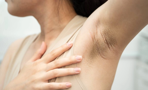 "รักแร้ดำ" อาจไม่ใช่แค่เรื่องความสวยงาม แต่เป็นสัญญาณการเกิดโรค