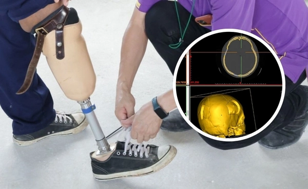 เทคโนโลยีเครื่องพิมพ์ 3D กะโหลกเทียม ขาเทียม ย่นระยะเวลาผ่าตัด ฟื้นฟูสมรรถภาพ