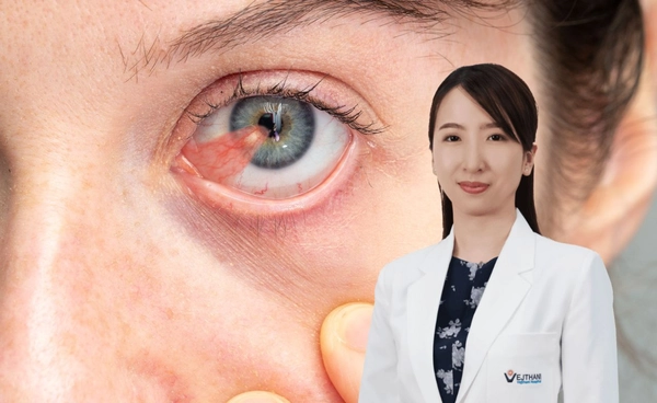 ระวัง แดด ฝุ่น ลม ตัวการ ต้อเนื้อที่อาจทำให้สายตาเอียงและมองไม่ชัดถาวร