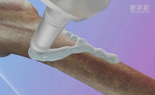 นักวิจัยจีนพัฒนา "กาวติดกระดูก" สำเร็จเป็นครั้งแรก 