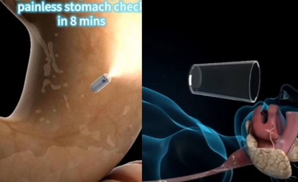 นวัตกรรมตรวจกระเพาะด้วยแคปซูลจิ๋ว ไม่เจ็บ ไม่มีแผล