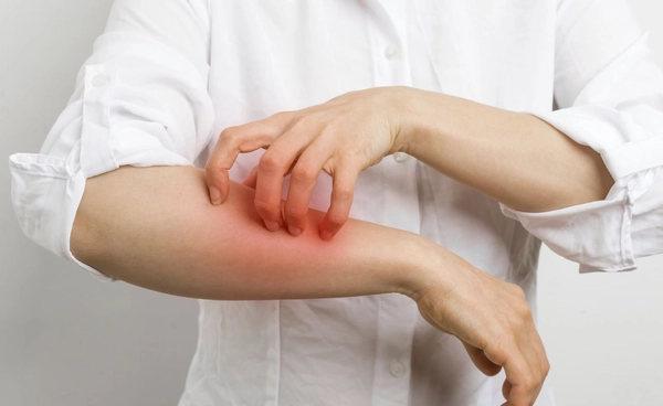 กลากไม่หายสักที หรือจะเป็นกลากดื้อยา