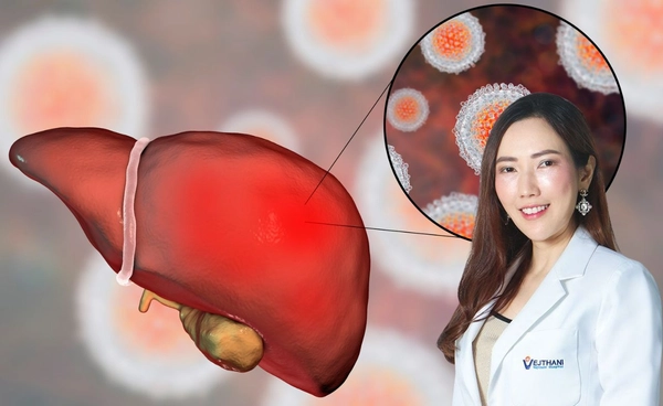 ไวรัสตับอักเสบ ปล่อยไว้นาน อาจลุกลามจนเกิด มะเร็งตับ