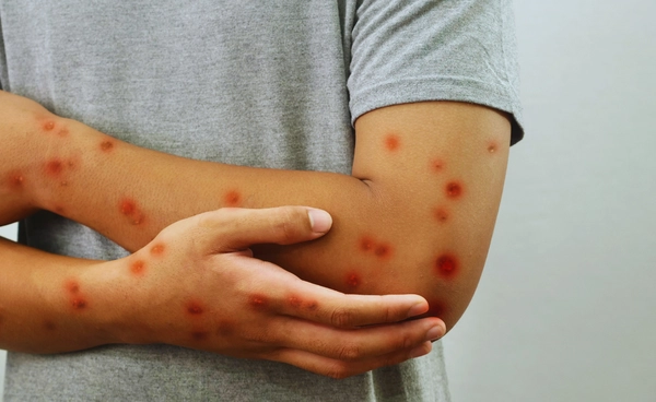 ฝีดาษลิง ยังต้องเฝ้าระวัง หลังป่วยสะสม 40 ราย  