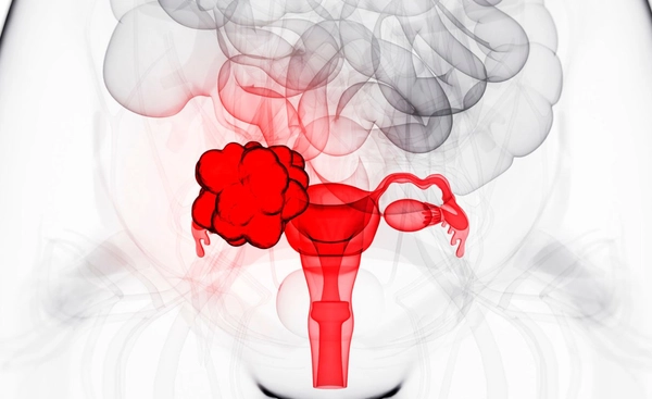 มะเร็งรังไข่ สาเหตุการเสียชีวิตมากที่สุด ในมะเร็งอวัยวะสืบพันธุ์ของผู้หญิง