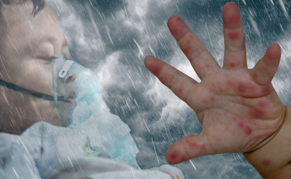 เตือน พบแนวโน้มของโรคมือ เท้า ปาก ในเด็กสูงขึ้น ป่วยสะสม 10,344 ราย