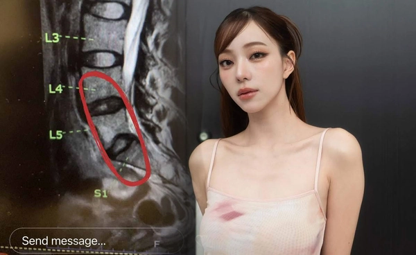 แอดมิทด่วน! นิวเคลียร์ หรรษา หมอนรองกระดูกเสื่อม โชคดีไม่ทับเส้นประสาท