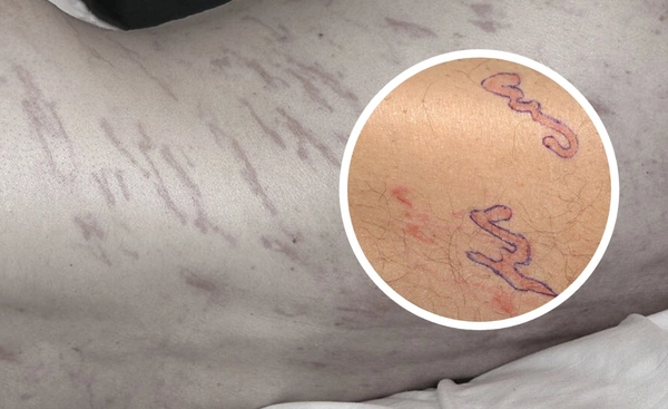 ชายวัย 64 ปี มีผื่นคัน ไม่ใช่รอยเกา รอยตี แต่นี่คือรอยไชของพยาธิเส้นด้าย