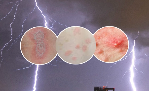 เตือนระวัง 7 โรคผิวหนังช่วงหน้าฝน แนะแนวทางการป้องกัน