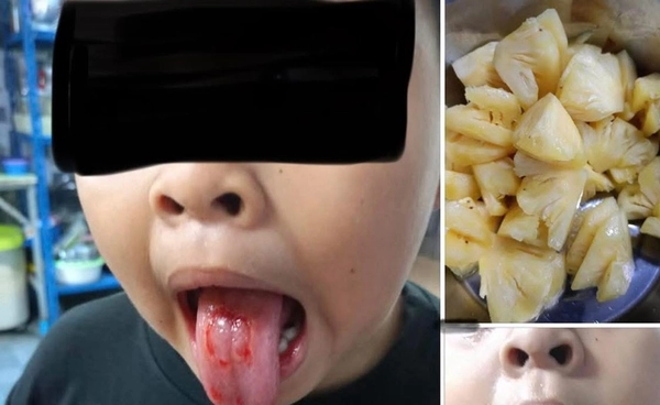 ทำไมกินสับปะรดแล้วแสบลิ้น? เปิด 2 สาเหตุหลักและวิธีแก้แบบได้ผล