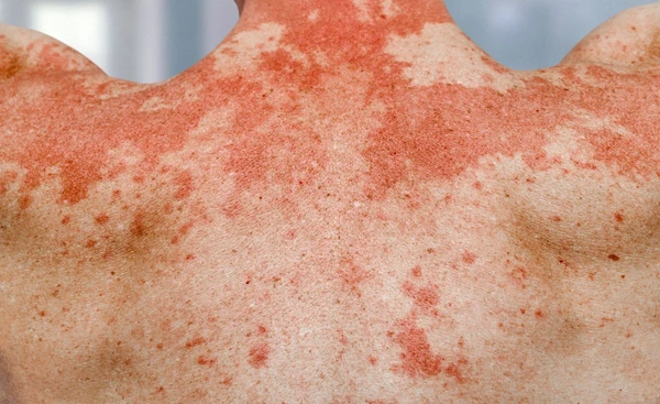 WHO ประกาศ โรคผิวหนัง เป็นประเด็นสาธารณสุขระดับโลก