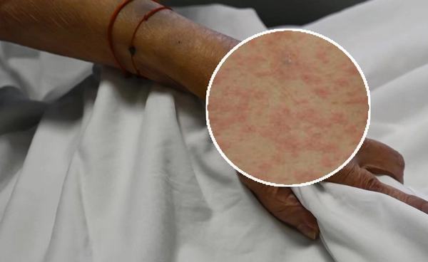 ผื่นกุหลาบ พบบ่อยช่วงฤดูฝน เช็กอาการแสดงเบื้องต้น-วิธีรักษา