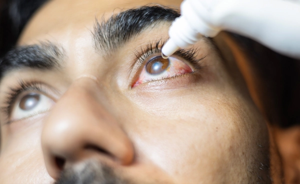 “โรคตาแดง” ที่แฝงมากับหน้าฝน เช็กอาการ-วิธีป้องกัน